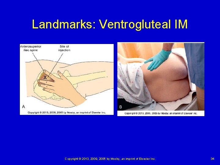 Landmarks: Ventrogluteal IM Copyright © 2013, 2009, 2005 by Mosby, an imprint of Elsevier