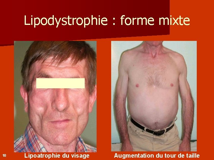 Lipodystrophie : forme mixte 10 Lipoatrophie du visage Augmentation du tour de taille 