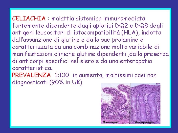 CELIACHIA : malattia sistemica immunomediata fortemente dipendente dagli aplotipi DQ 2 e DQ 8