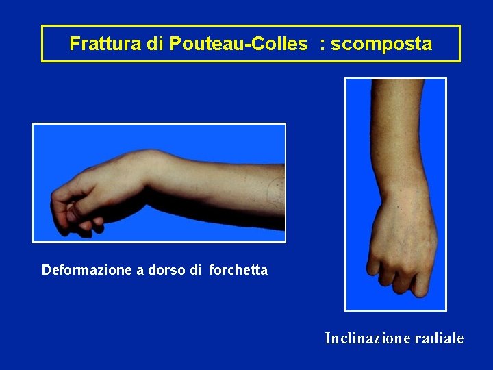 Fratture Di Polso Fratture Dellestremit Distale Di Radio