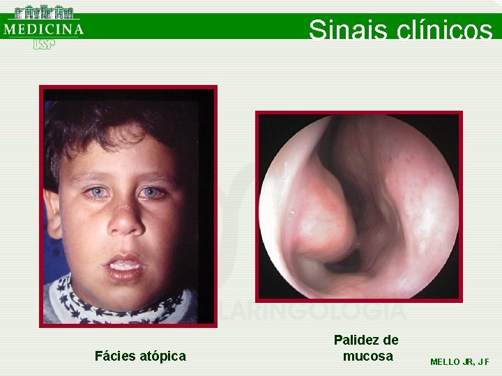 Sinais clínicos Fácies atópica Palidez de mucosa MELLO JR, J F Sinais clínicos Fácies atópica Palidez de mucosa MELLO JR, J F