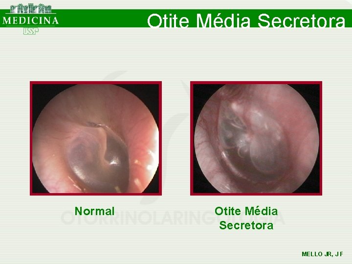 Otite Média Secretora Normal Otite Média Secretora MELLO JR, J F Otite Média Secretora Normal Otite Média Secretora MELLO JR, J F