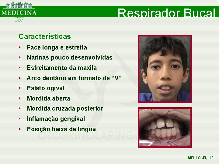 Respirador Bucal Características • Face longa e estreita • Narinas pouco desenvolvidas • Estreitamento Respirador Bucal Características • Face longa e estreita • Narinas pouco desenvolvidas • Estreitamento
