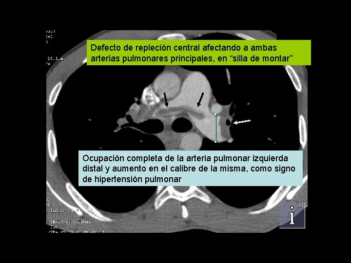 Defecto de repleción central afectando a ambas arterias pulmonares principales, en “silla de montar”