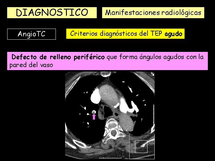 DIAGNOSTICO Angio. TC Manifestaciones radiológicas Criterios diagnósticos del TEP agudo Defecto de relleno periférico