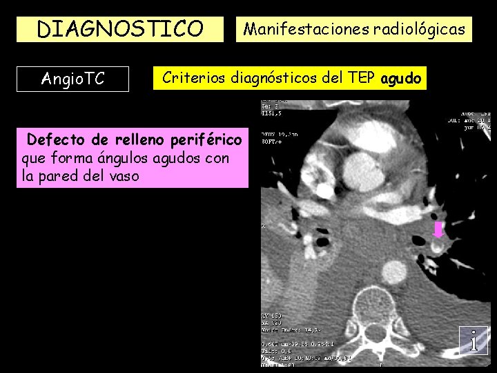 DIAGNOSTICO Angio. TC Manifestaciones radiológicas Criterios diagnósticos del TEP agudo Defecto de relleno periférico