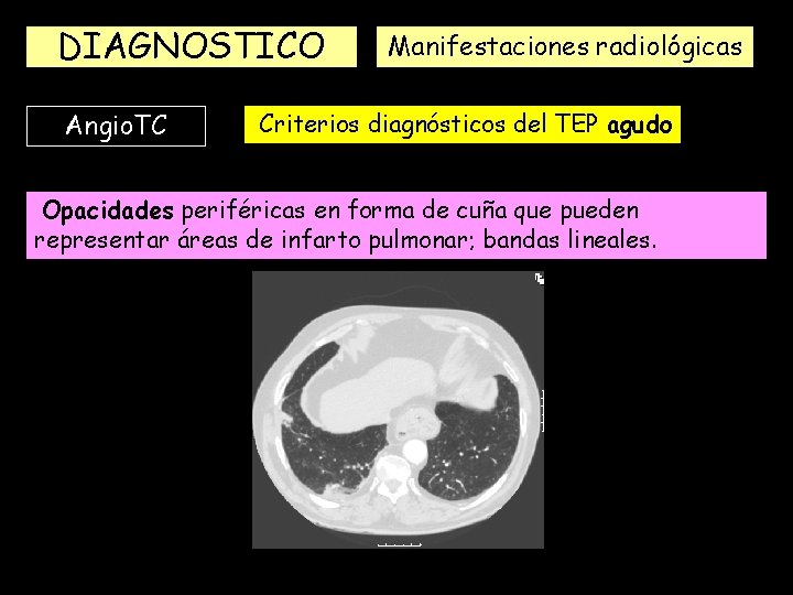 DIAGNOSTICO Angio. TC Manifestaciones radiológicas Criterios diagnósticos del TEP agudo Opacidades periféricas en forma