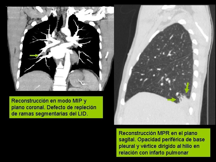 Reconstrucción en modo MIP y plano coronal. Defecto de repleción de ramas segmentarias del