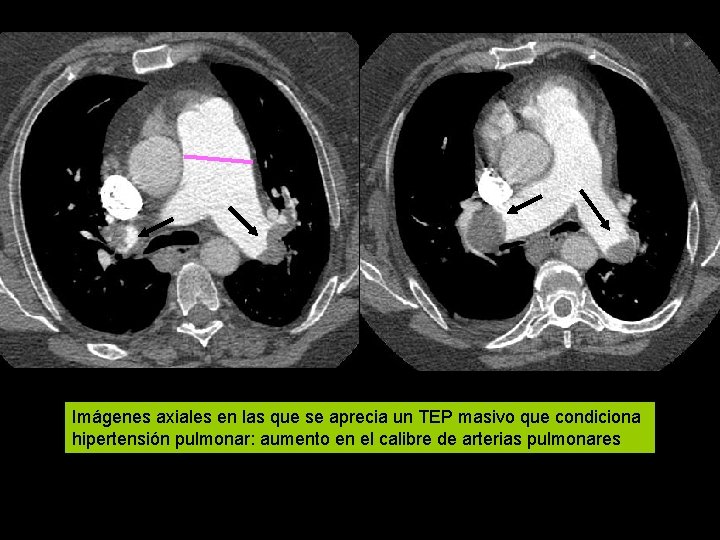 Imágenes axiales en las que se aprecia un TEP masivo que condiciona hipertensión pulmonar: