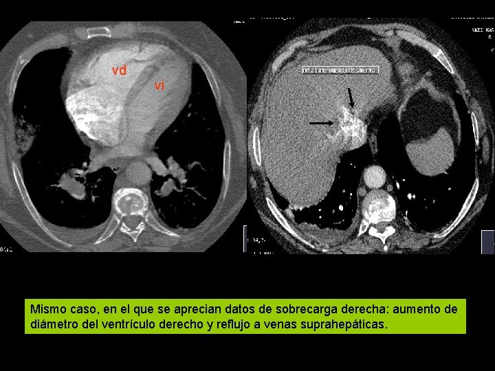 vd vi Mismo caso, en el que se aprecian datos de sobrecarga derecha: aumento vd vi Mismo caso, en el que se aprecian datos de sobrecarga derecha: aumento