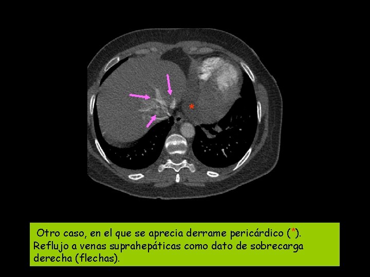 * Otro caso, en el que se aprecia derrame pericárdico ( *). Reflujo a