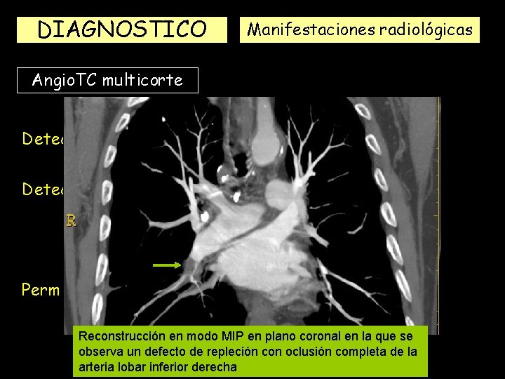 DIAGNOSTICO Manifestaciones radiológicas Angio. TC multicorte Detecta mejor los émbolos subsegmentarios Detecta mejor el DIAGNOSTICO Manifestaciones radiológicas Angio. TC multicorte Detecta mejor los émbolos subsegmentarios Detecta mejor el