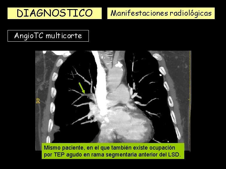 DIAGNOSTICO Manifestaciones radiológicas Angio. TC multicorte Mismo paciente, en el que también existe ocupación