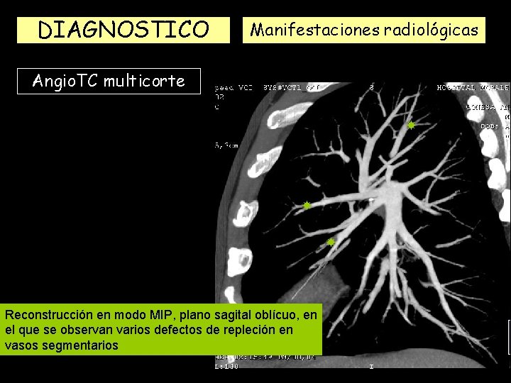 DIAGNOSTICO Manifestaciones radiológicas Angio. TC multicorte Reconstrucción en modo MIP, plano sagital oblícuo, en