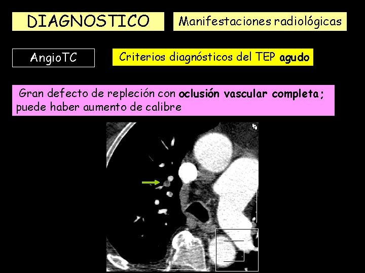 DIAGNOSTICO Angio. TC Manifestaciones radiológicas Criterios diagnósticos del TEP agudo Gran defecto de repleción