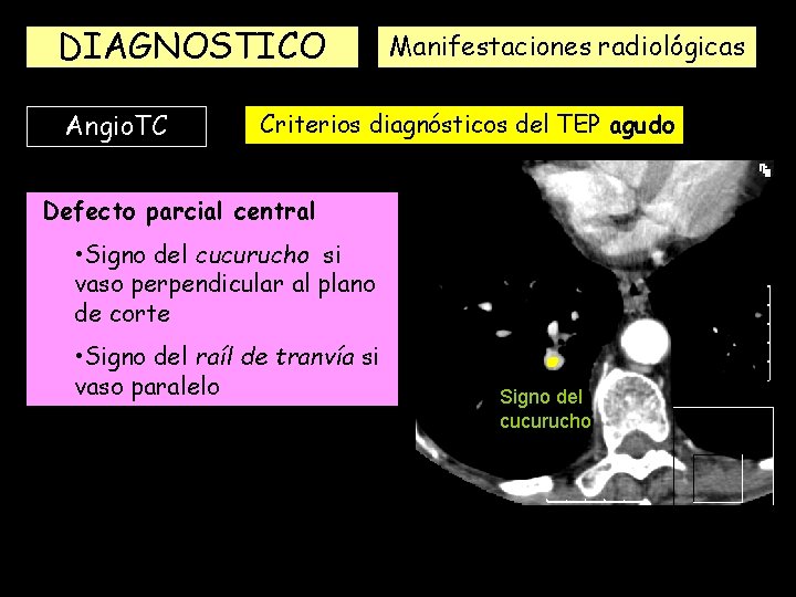 DIAGNOSTICO Angio. TC Manifestaciones radiológicas Criterios diagnósticos del TEP agudo Defecto parcial central •