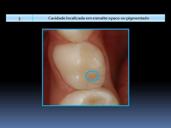 3 Cavidade localizada em esmalte opaco ou pigmentado 