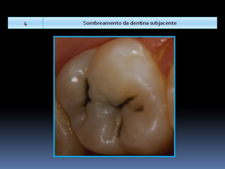 4 Sombreamento da dentina subjacente 