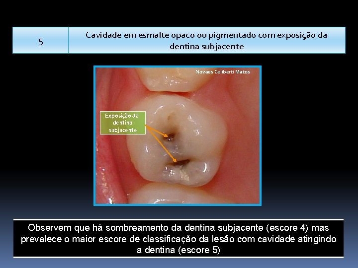 5 Cavidade em esmalte opaco ou pigmentado com exposição da dentina subjacente Novaes Celiberti