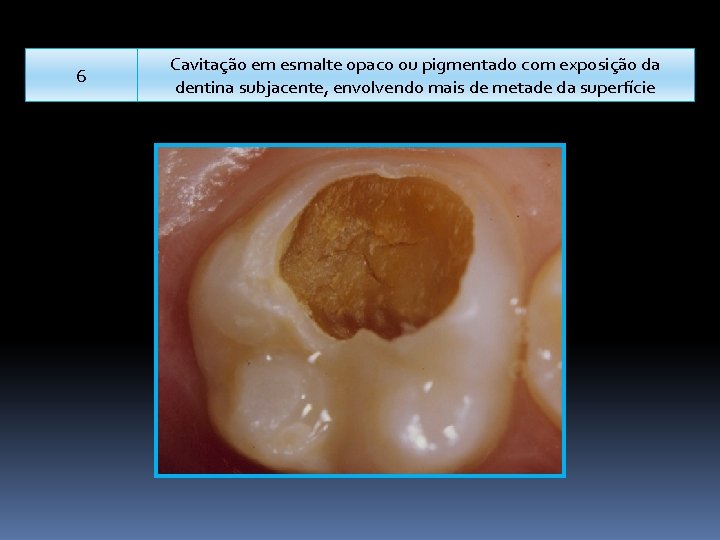 6 Cavitação em esmalte opaco ou pigmentado com exposição da dentina subjacente, envolvendo mais