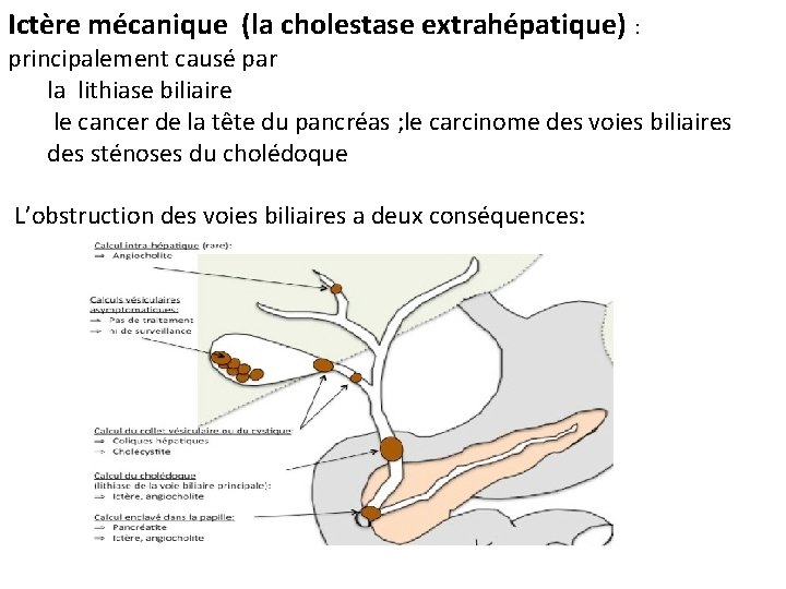 Ictère mécanique (la cholestase extrahépatique) : principalement causé par la lithiase biliaire le cancer