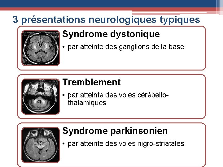 3 présentations neurologiques typiques Syndrome dystonique • par atteinte des ganglions de la base