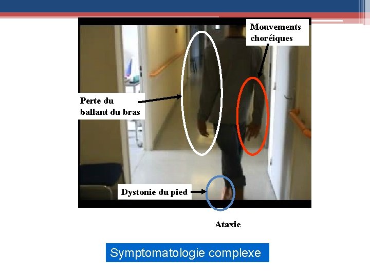 Mouvements choréiques Perte du ballant du bras Dystonie du pied Ataxie Symptomatologie complexe 