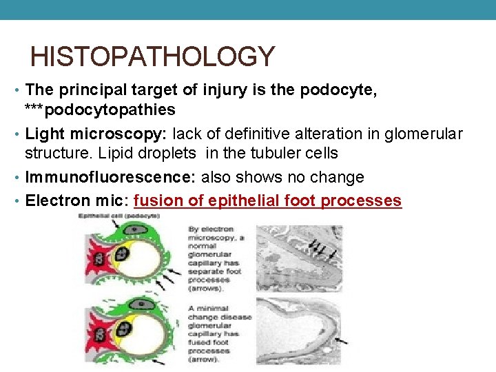 HISTOPATHOLOGY • The principal target of injury is the podocyte, ***podocytopathies • Light microscopy: