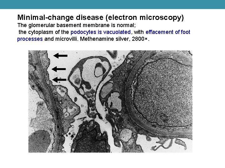 Minimal-change disease (electron microscopy) The glomerular basement membrane is normal; the cytoplasm of the