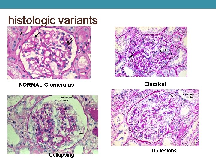 histologic variants NORMAL Glomerulus Collapsing Classical Tip lesions 