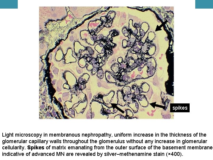 spikes Light microscopy in membranous nephropathy, uniform increase in the thickness of the glomerular