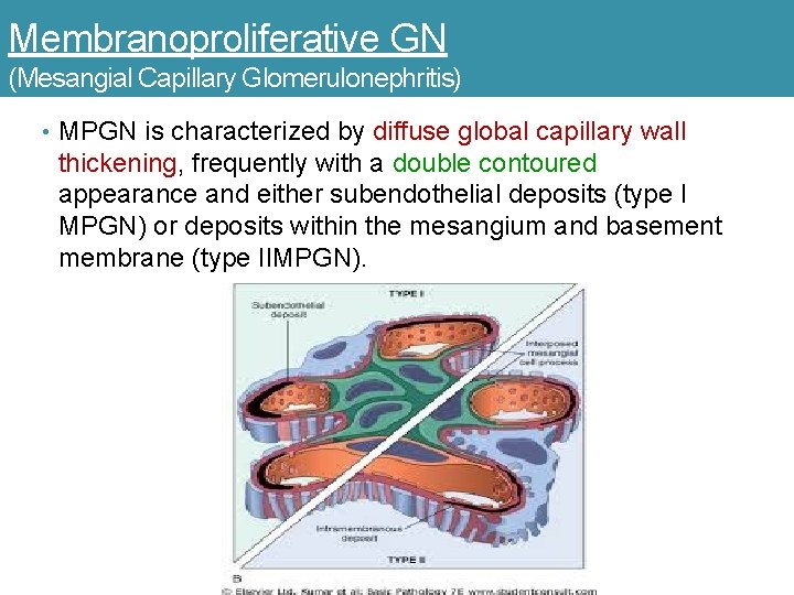 Membranoproliferative GN (Mesangial Capillary Glomerulonephritis) • MPGN is characterized by diffuse global capillary wall