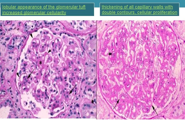 lobular appearance of the glomerular tuft increased glomerular cellularity thickening of all capillary walls