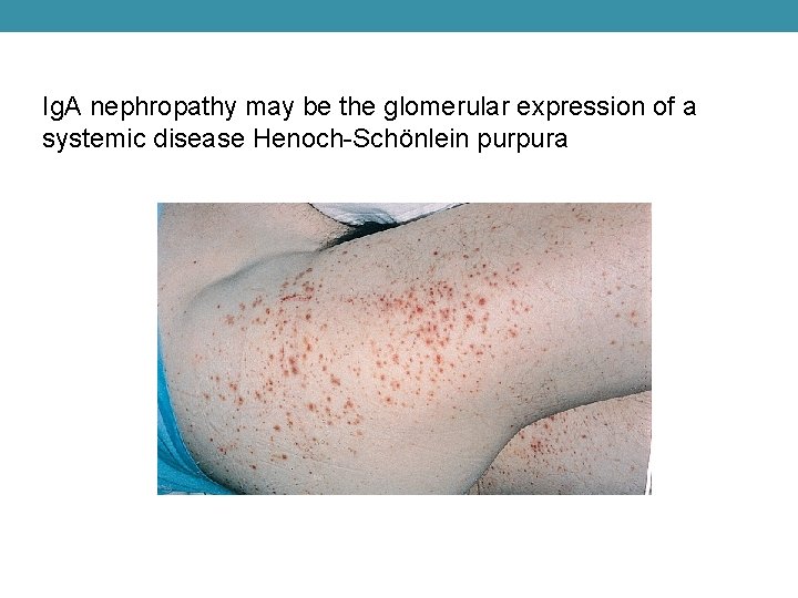 Ig. A nephropathy may be the glomerular expression of a systemic disease Henoch-Schönlein purpura