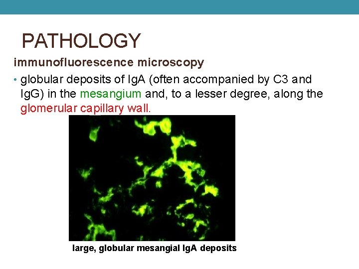 PATHOLOGY immunofluorescence microscopy • globular deposits of Ig. A (often accompanied by C 3