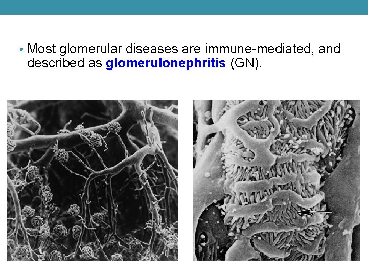  • Most glomerular diseases are immune-mediated, and described as glomerulonephritis (GN). 