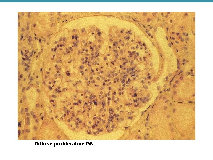 Diffuse proliferative GN 