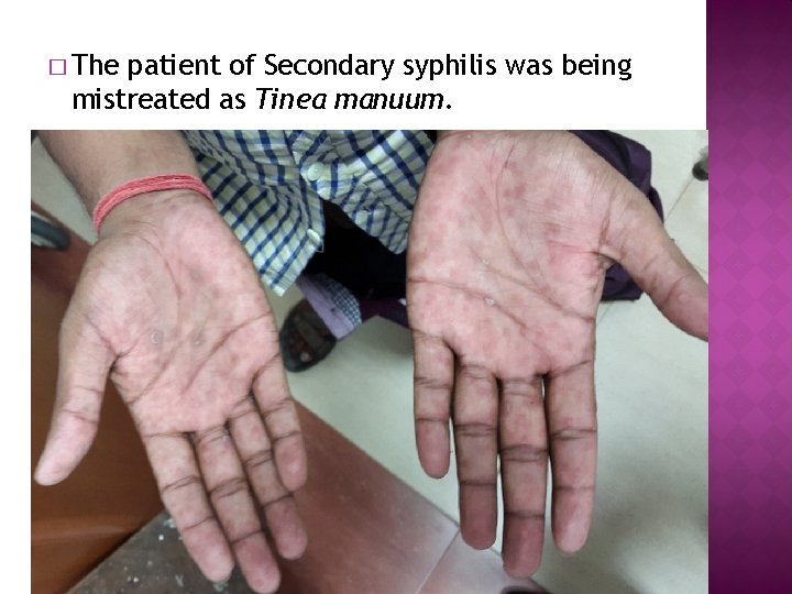 � The patient of Secondary syphilis was being mistreated as Tinea manuum. 