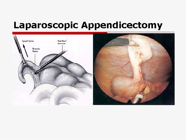 Laparoscopic Appendicectomy Laparoscopic Appendicectomy
