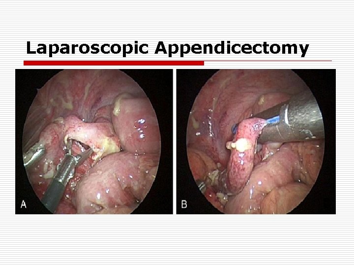 Laparoscopic Appendicectomy Laparoscopic Appendicectomy