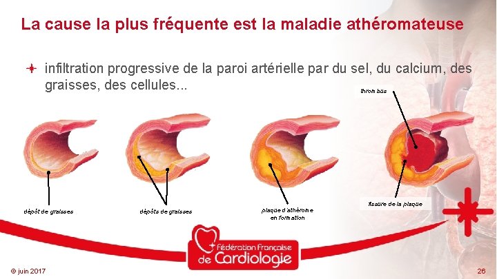 La cause la plus fréquente est la maladie athéromateuse infiltration progressive de la paroi