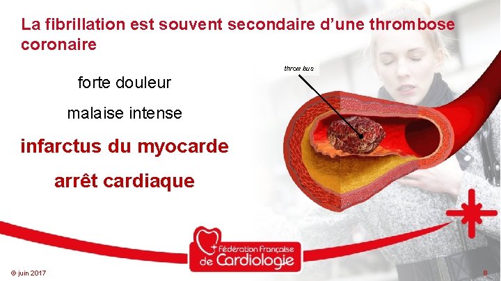 La fibrillation est souvent secondaire d’une thrombose coronaire thrombus forte douleur malaise intense infarctus