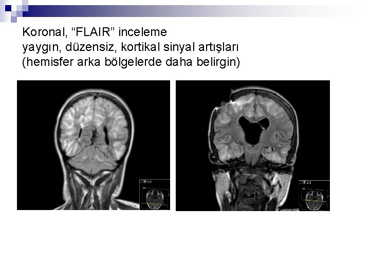 Koronal, “FLAIR” inceleme yaygın, düzensiz, kortikal sinyal artışları (hemisfer arka bölgelerde daha belirgin) 