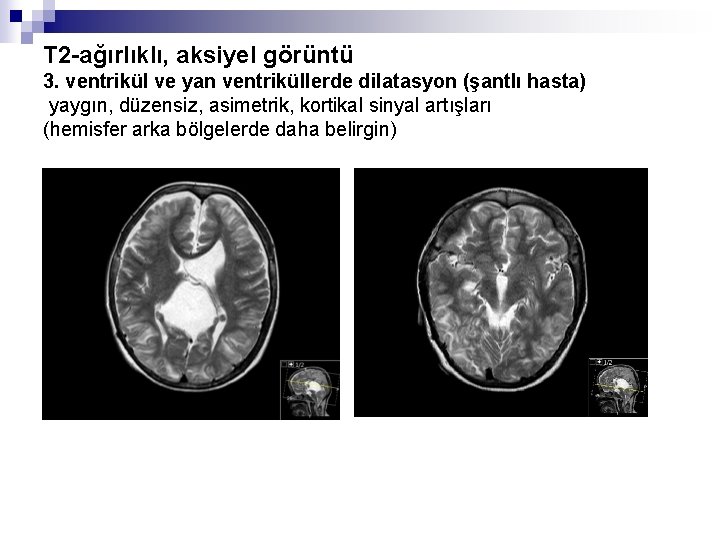 T 2 -ağırlıklı, aksiyel görüntü 3. ventrikül ve yan ventriküllerde dilatasyon (şantlı hasta) yaygın,