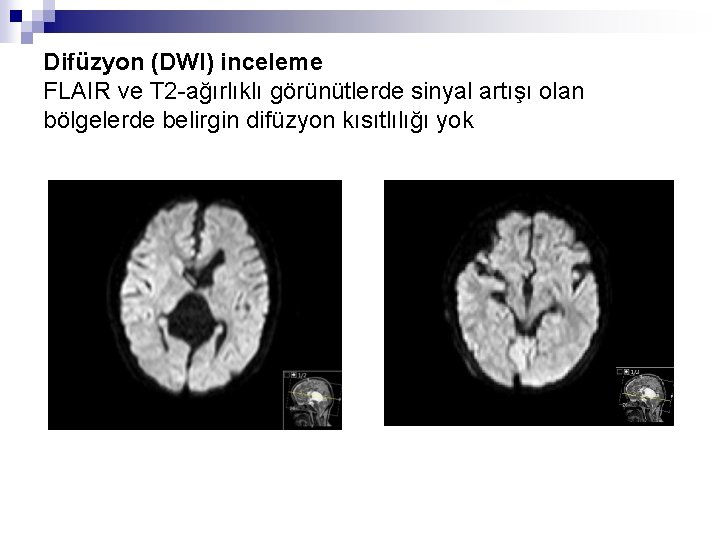 Difüzyon (DWI) inceleme FLAIR ve T 2 -ağırlıklı görünütlerde sinyal artışı olan bölgelerde belirgin