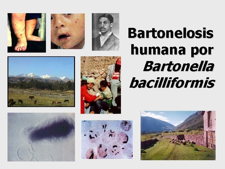 Bartonelosis humana por Bartonella bacilliformis 