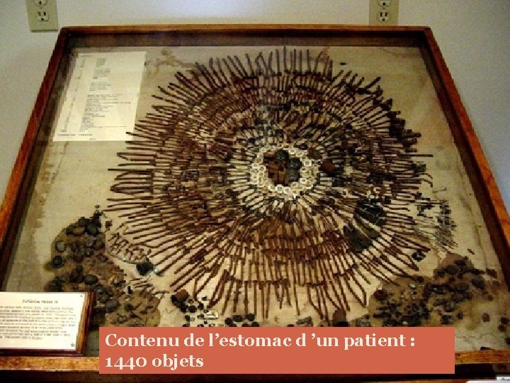 Contenu de l’estomac d ’un patient : 1440 objets 