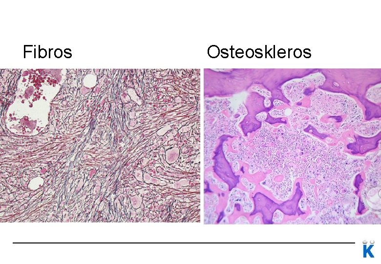 Fibros Osteoskleros 