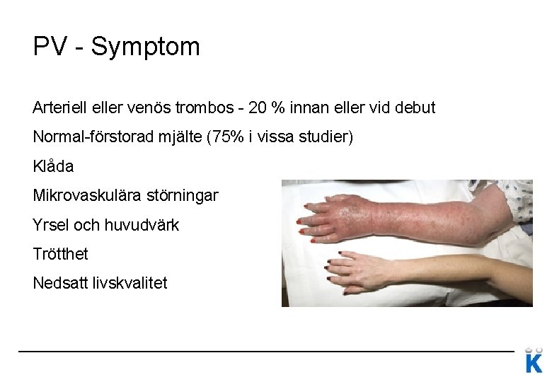 PV - Symptom Arteriell eller venös trombos - 20 % innan eller vid debut PV - Symptom Arteriell eller venös trombos - 20 % innan eller vid debut