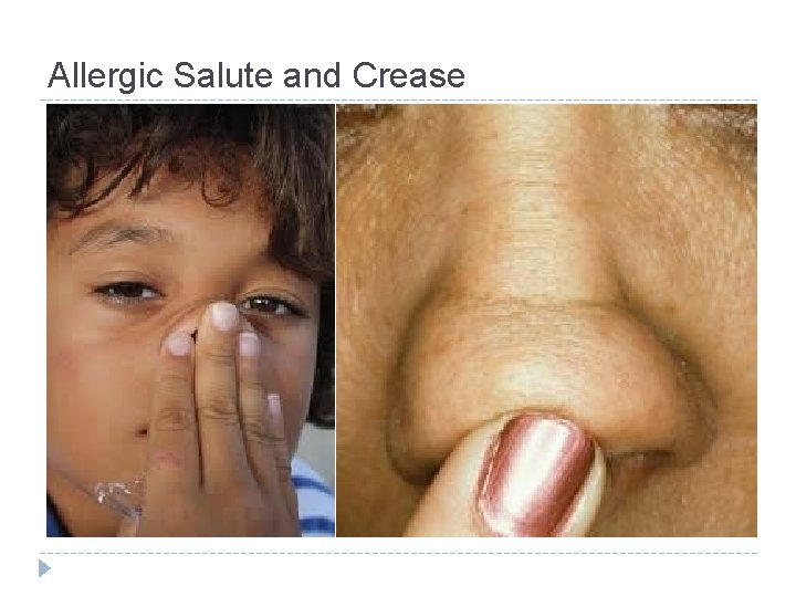 Allergic Salute and Crease 